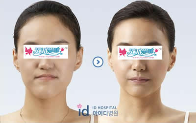 面部反颌整形手术对比案例-韩国朴相熏id整形