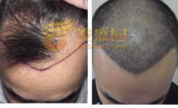 发际线种植成功案例-北京发盛园专科植发医院