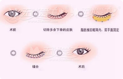 上海九院2015年割双眼皮去眼袋价格-上海第九