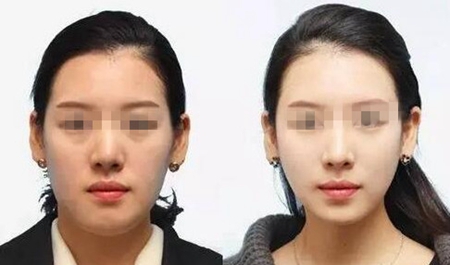 安阳苏莱美暑期整形优惠 双眼皮手术680元-安