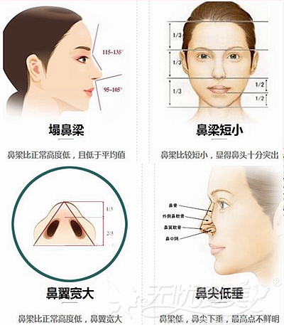 长沙爱思特隆鼻手术好吗 价格贵不贵