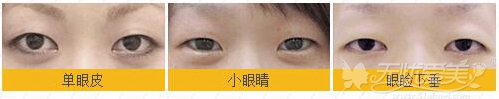 锦州锦美双眼皮手术方法和价格