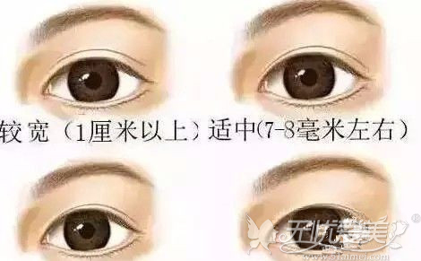 福州海峡彭利涛医生如何用巧手修复双眼皮-福