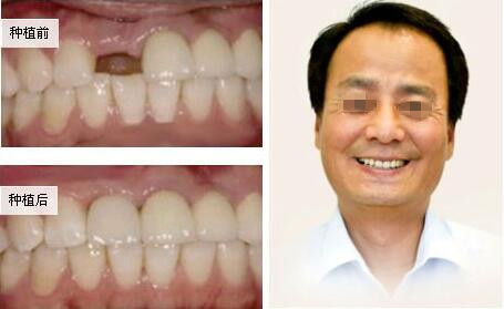 郑州植得口腔3d微创种植牙前后对比案例