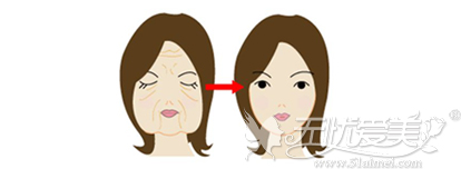 较好的面部除皱方法是什么？沈阳杏林电波拉皮术让你回春