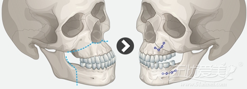 > 医院新闻 双鄂手术其实就是调整上颌(上颚)与下颌(下颚)位置