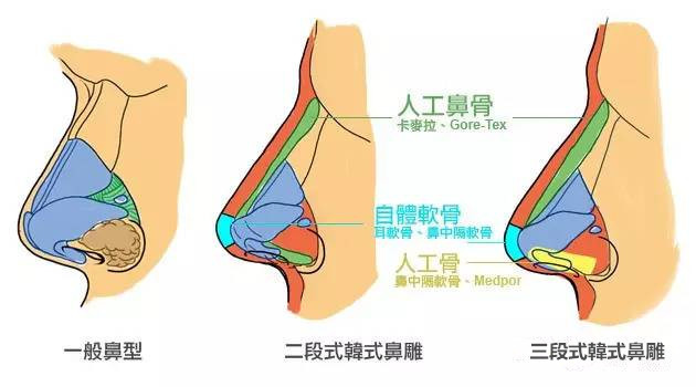 广州艺美医疗美容整形医院隆鼻手术分析介绍-