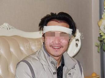26岁小伙脱发3年,在北京博士园5小时植发手术