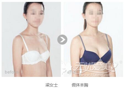 亳州缔美隆胸手术怎么样?多少钱?