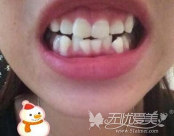 深圳非凡做牙齿矫正有哪些方法要花多少钱?