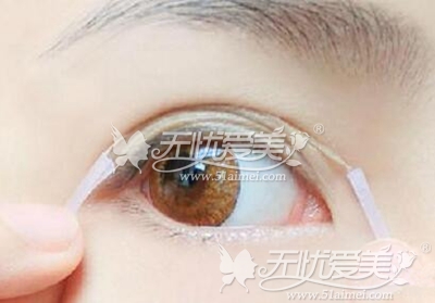 天津欧菲哪位医生做双眼皮技术好?手术价格呢?