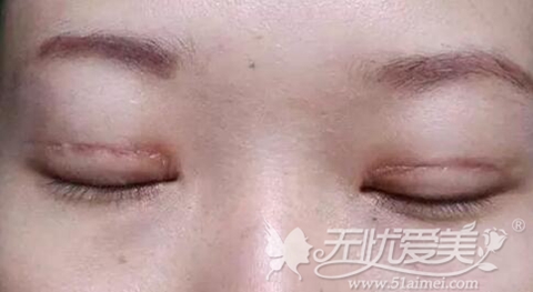 西安西京医院双眼皮修复多少钱?有没有修复实例?
