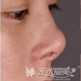深圳非凡隆鼻手术做的怎么样多少钱?鼻孔外露能改善吗?