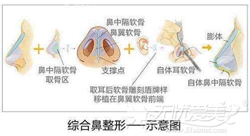 衡水唯美和尚美谁做隆鼻效果好 有没有隆鼻整形的价格表？