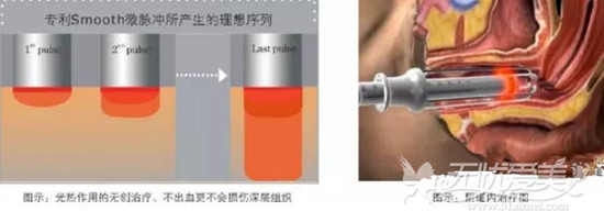 北京做激光缩阴手术多少钱?推荐一家医院吧!