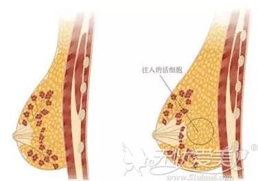 天水市自体脂肪丰胸多少钱?手术有什么危害吗?