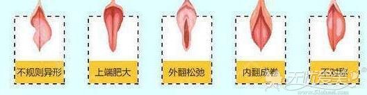 阴唇肥大是由什么造成的?杭州薇琳阴唇肥大整形需要多少钱?