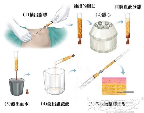 南京手臂抽脂多少钱？南京连天美提供抽脂价目表展示效果