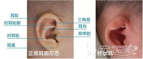 杯状耳整形手术需要多少钱?北京亚馨美莱坞根据程度2万元起
