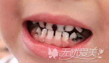 3岁儿童牙齿发黑烂掉,孩妈却说没必要做龋齿治疗反正要换牙