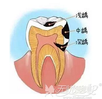 解析龋齿的不同程度