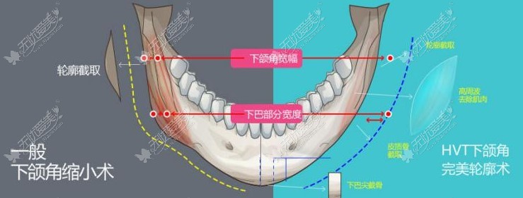 重庆时光河东镐下颌角截骨技术优势