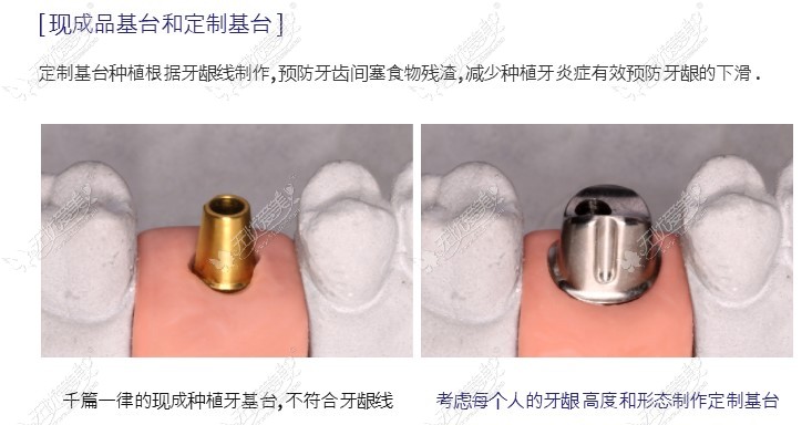 韩国minish牙科医院种植牙带牙冠优势