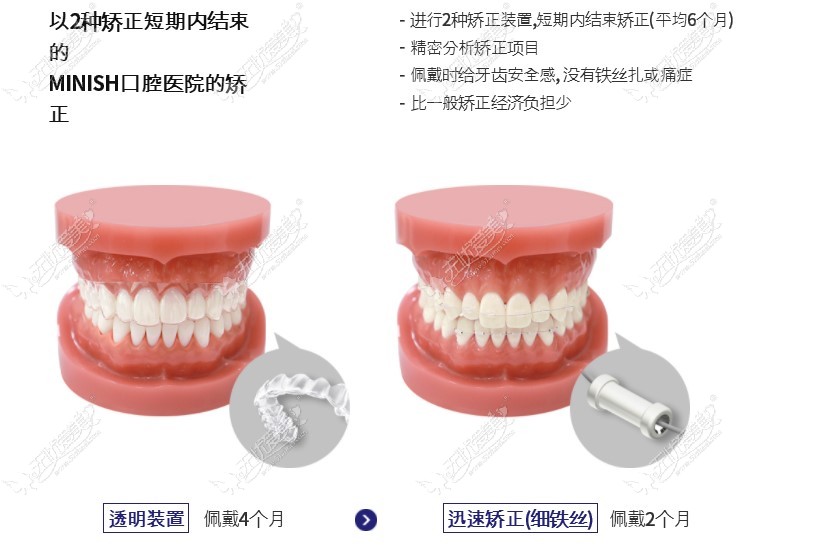 韩国minish牙科牙齿矫正技术优势