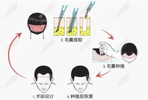 东莞尚青逸植发主要做MIH微针种植头发技术优势