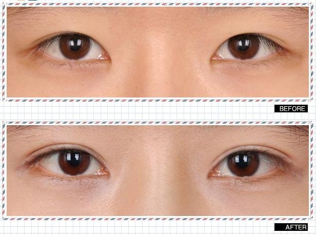 申九双眼皮成形术前后对比图
