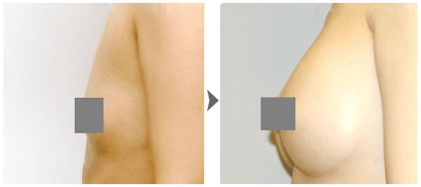 成都温江达拉斯整形隆胸手术案例对比图