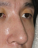 驼峰鼻矫正手术对比照片