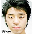 面部轮廓整形手术前后对比图