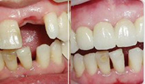 术后的种植牙与自己的牙齿自然融合
