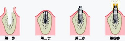 种植牙术中，经过牙龈成形、上部修复