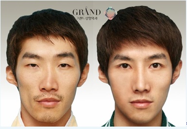 如何选择韩国隆鼻的整形外科医院？