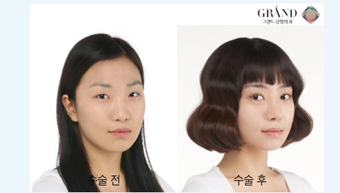 韩国双眼皮整形——自然粘连法