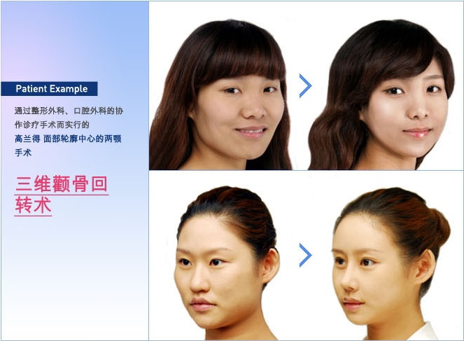 韩国较尖端改脸型中心：韩国高兰得整形外科
