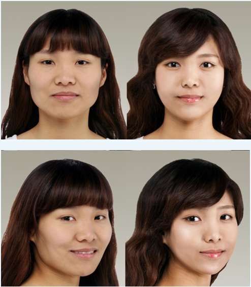 韩国脸部轮廓整形术必知常识