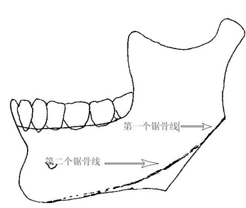 长曲线弧形下颌角手术 风靡京城