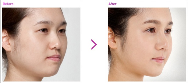 [高兰得整形外科]鼻子修复手术 前后照片