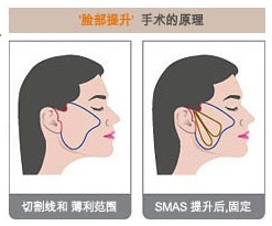 衰老后的面部下垂’，‘MACS提升术’可以解决！