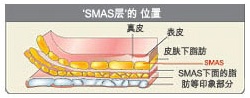 衰老后的面部下垂’，‘MACS提升术’可以解决！