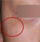 PRP皮肤再生术前后对比照片