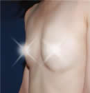 +脂肪移植胸部整形前后对比照片术前