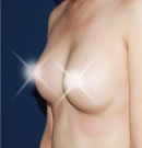 +脂肪移植胸部整形前后对比照片术后