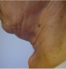 颈部除皱术前与术后7个月对比照片