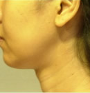 颈部除皱术前与术后两年对比照片