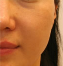 脸部皮肤颜色和毛孔改善术前与术后6个月对比照片