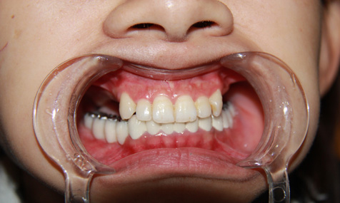 青春女孩变“无齿”被无良牙医拔走14颗牙齿